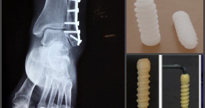 "Make in India" biodegradable screws for fixing bone injuries ...